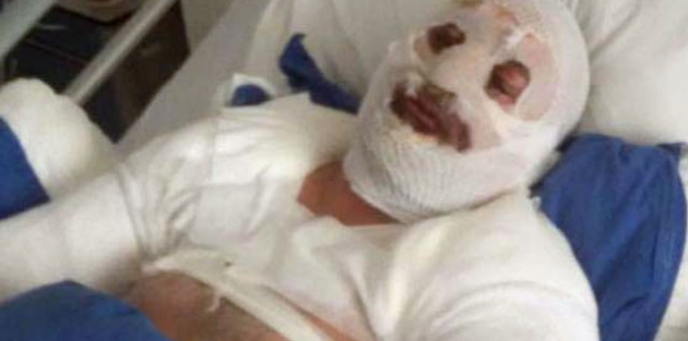 Saç kurutma makinesini çalıştırdı, patlamada bu hale geldi