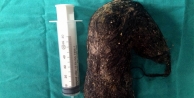 Midesinden 850 gram saç çıktı